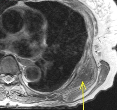 Figure 6 for case Elastofibroma dorsi